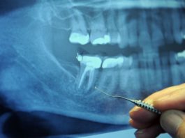 Перед заболеванием 97% больных раком делали эту стоматологическую процедуру